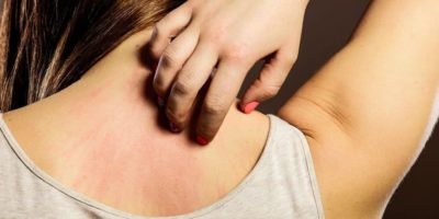 Dermatitis por el uso de cosmeticos