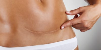 Proteger las cicatrices del sol